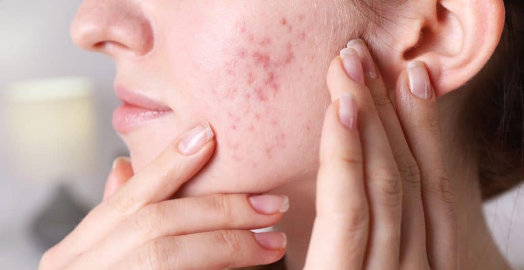 Hormonal Acne