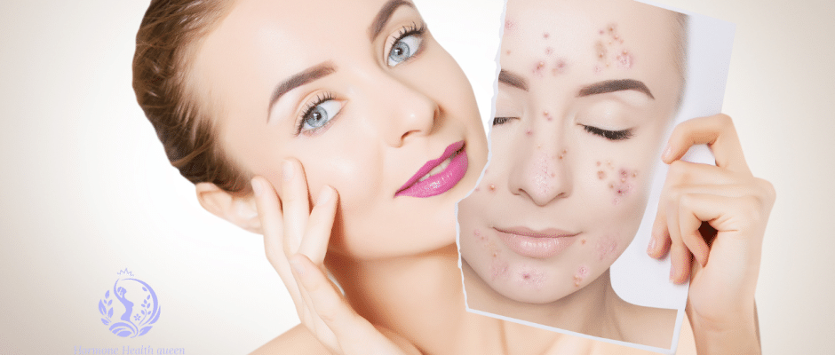 Hormonal Acne Unmasked: 3 Surprising Triggers, Treatments, and the Hidden Emotional Toll