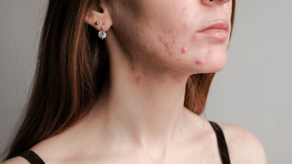 hormonal acne