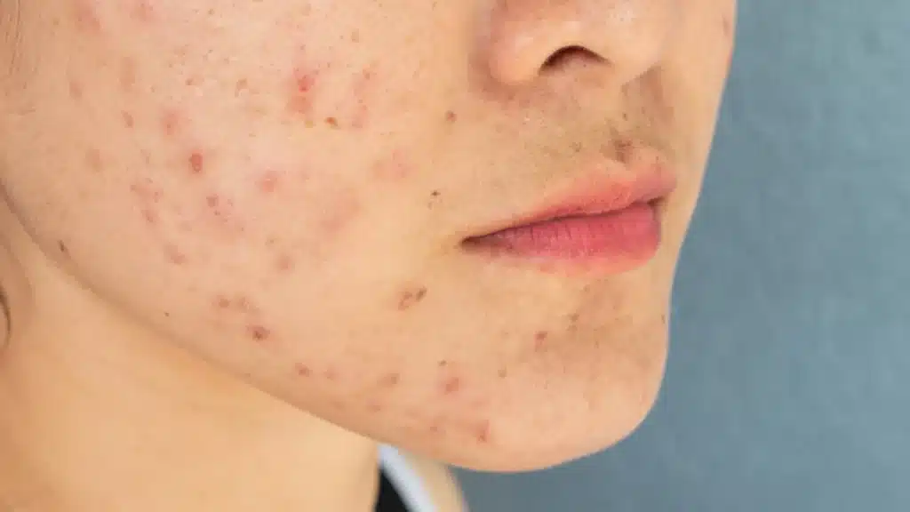 Period Acne solutions