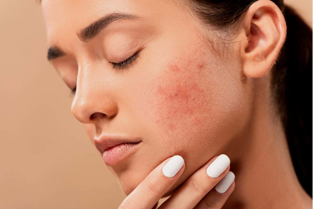 how to manage hormonal acne