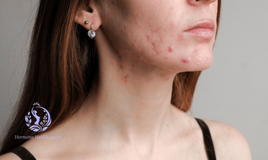 Hormonal Acne & Diet: The Foods Connection Your Dermatologist Isn't Telling You