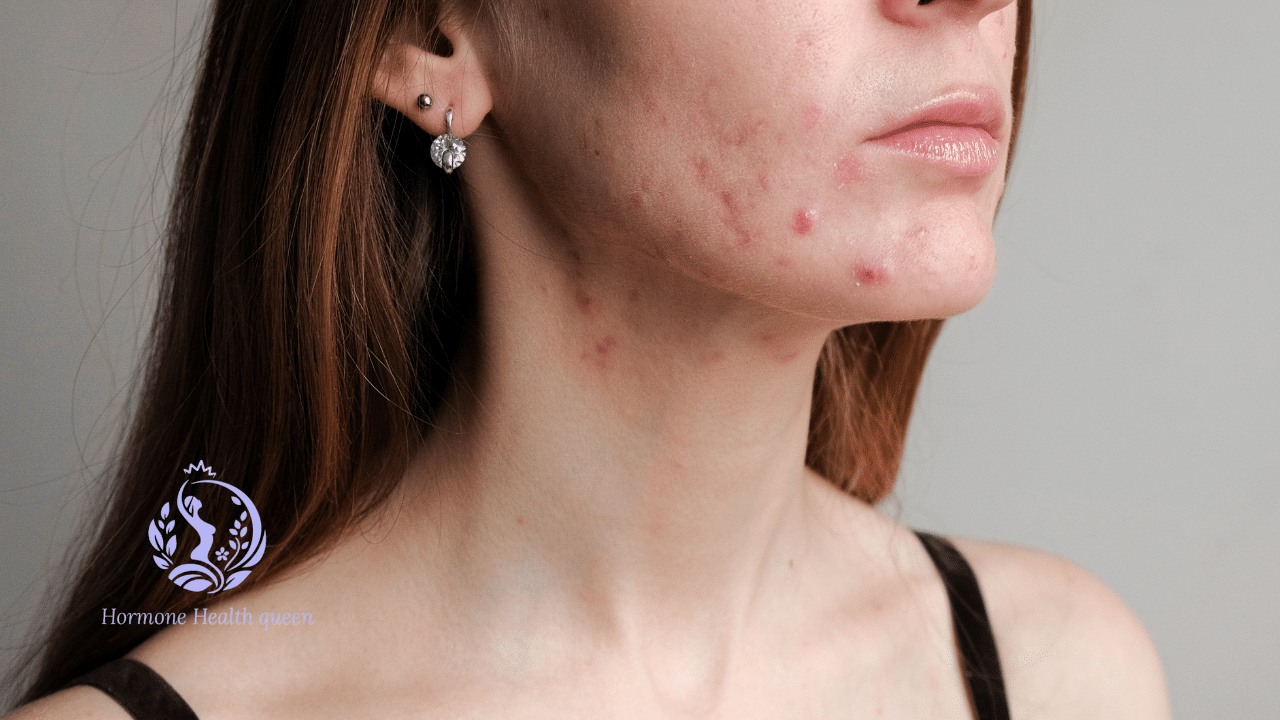 Hormonal Acne & Diet: The Foods Connection Your Dermatologist Isn’t Telling You