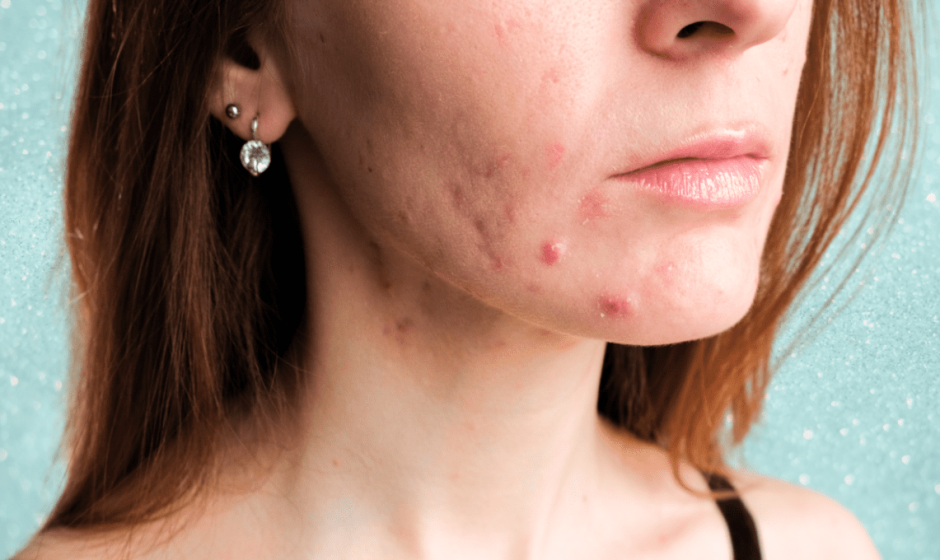 Hormonal Acne Decoded: 6 Natural Treatments That Actually Work