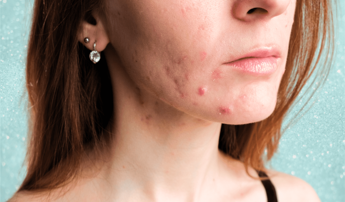 Hormonal Acne Decoded: 6 Natural Treatments That Actually Work