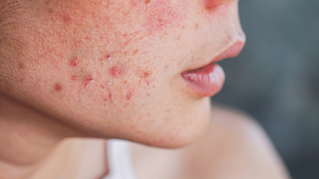 hormonal acne