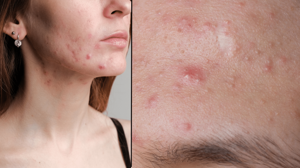 Hormonal acne location map showing jaw and chin breakouts versus regular acne breakouts on forehead and nose