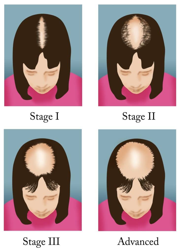 Female Pattern Baldness Progression Map
